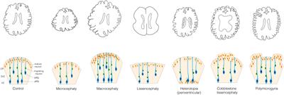 Roots of the Malformations of Cortical Development in the Cell Biology of Neural Progenitor Cells